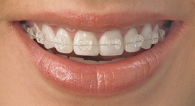 Adult Braces Can Be Fast and Safe