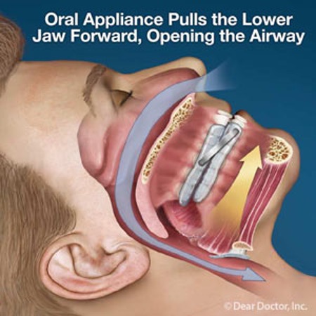 A Proven Dental Treatment For Sleep Apnea Sufferers