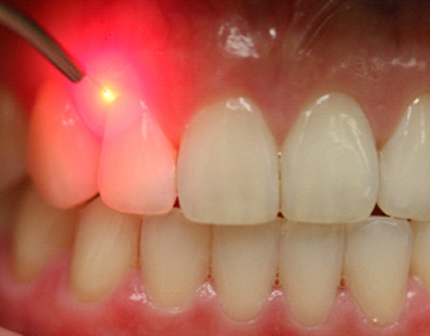 LASER THERAPY CAN MAKE YOUR DENTAL CLEANING MORE EFFECTIVE