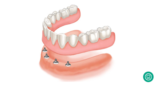 Mini Dental Implants Are Great Alternatives to Conventional Implants