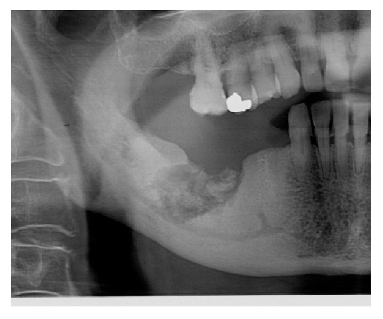 OSTEOPOROSIS: A SERIOUS BONE DISEASE THAT MAY CAUSE TOOTH LOSS