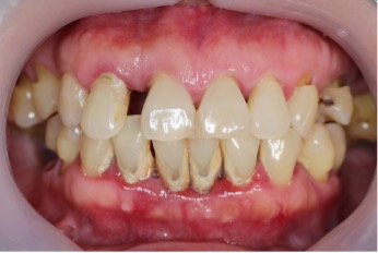 Gum Disease Can Be A Debilitating Public Health Menace