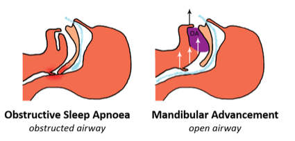 Obstructive Sleep Apnea Is Prevalent Among Bahamians