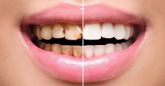 A Smile Makeover: A Great Life Changing Option
