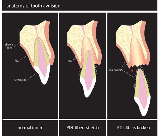 Act Fast When a Tooth Gets Knocked Out