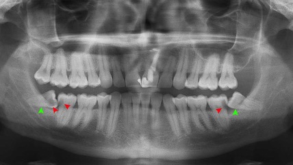 Should I Have My Wisdom Teeth Removed?