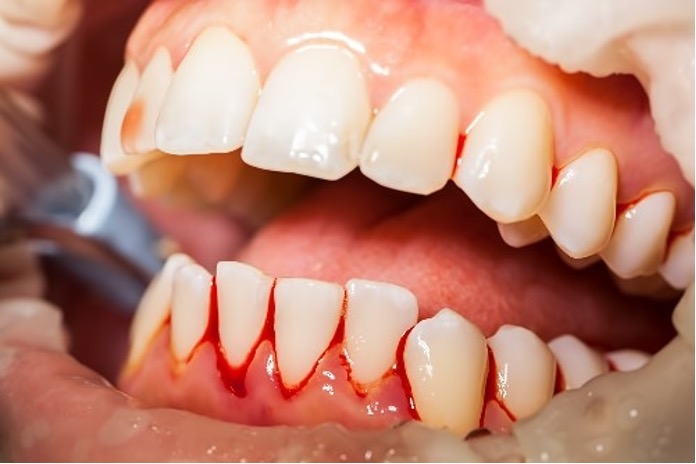 BLEEDING GUMS ARE A SERIOUS CONCERN