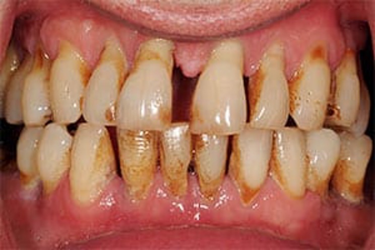 Gum Disease: Don’t Wait Until It Hurts!