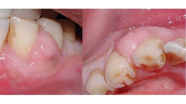 Treating Gum Disease- A Pathway to Saving Teeth and Your Life