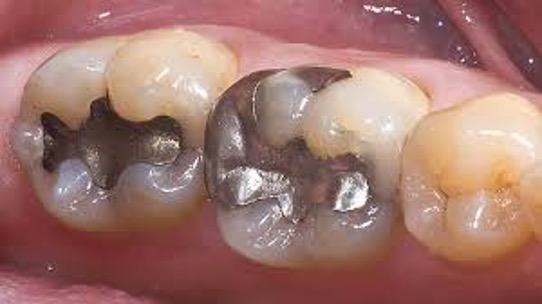 Should Dental Silver Fillings Be Removed?