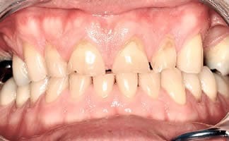 Teeth Grinding Causes Serious Oral Health Complications