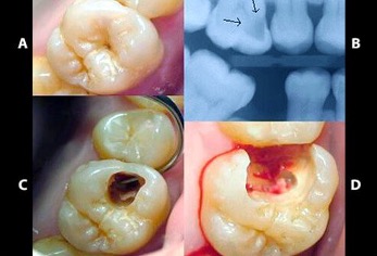 Tooth Extraction Is Not Always The Best Option