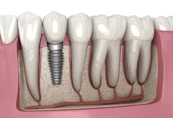 DENTAL IMPLANTS – What You Should Know!