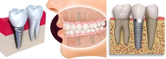 BEST ALTERNATIVE TO TEETH REPLACEMENT: DENTAL IMPLANTS