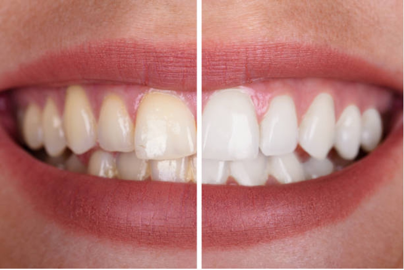 The Benefits of Teeth Whitening