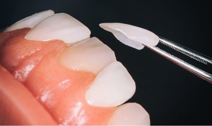 Dental Veneers Can Enhance Your Smile!