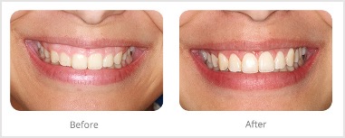 Advances in Gum Disease Treatment