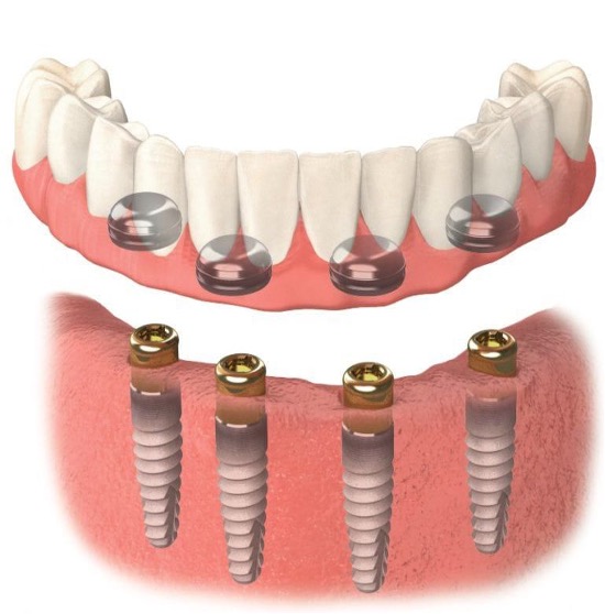 Three Dangers of Tooth Loss and Poor Fitting Dentures