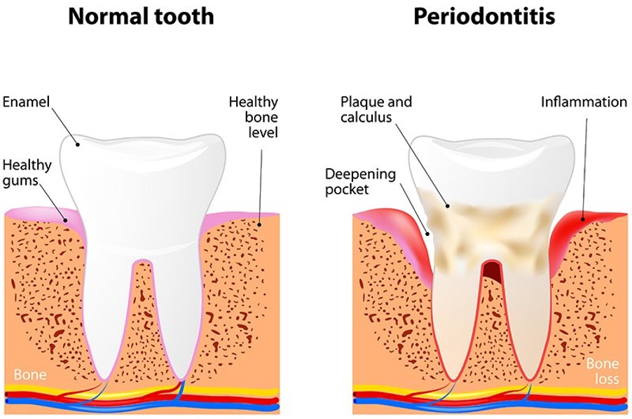 Gum Disease Affects Over 70% Of Adults