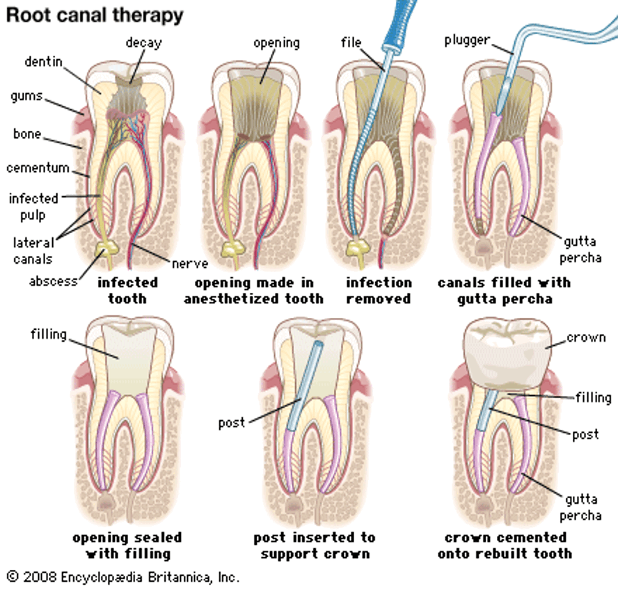 “You need a Root Canal”