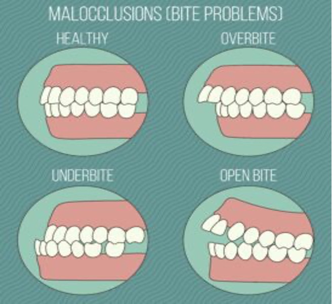 Benefits of Wearing Braces