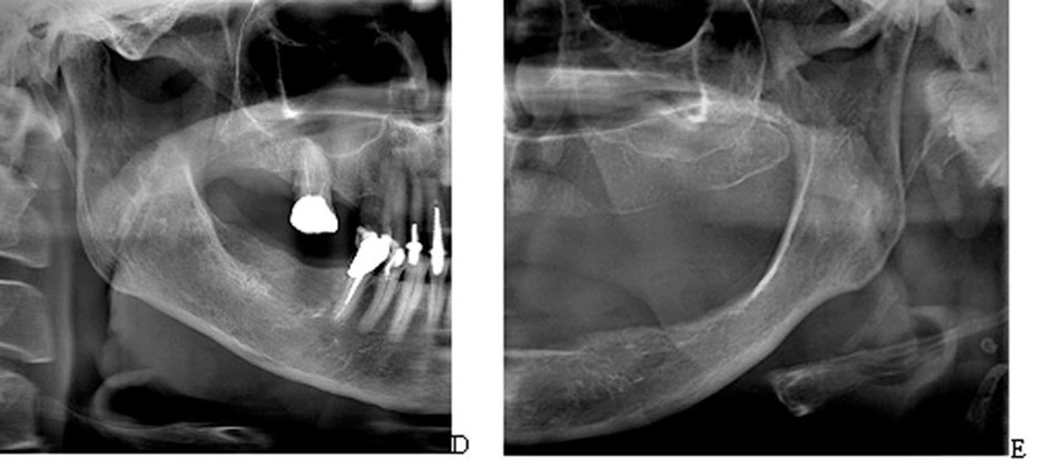 OSTEOPOROSIS AND ITS COMPLICATIONS TO DENTAL HEALTH