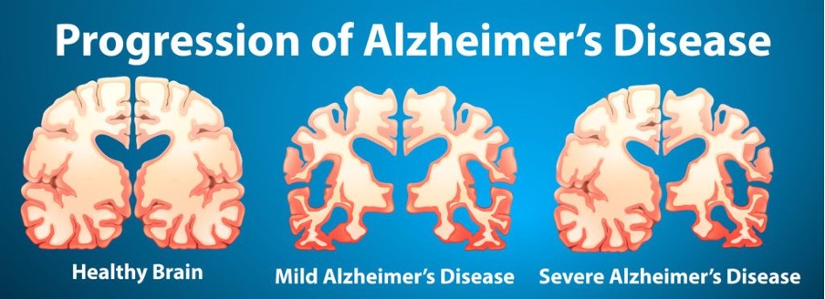 Poor Oral Health & Alzheimer’s Disease