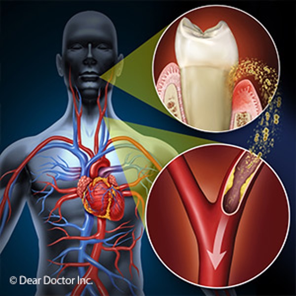 Your Gums: A Predictor of Heart Disease