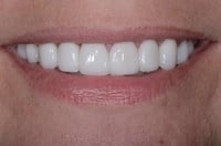 How Veneers Can Enhance Your Smile