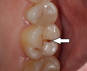 Dental Sealants: A Cost-effective Cavity Prevention Treatment