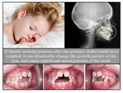 THUMB AND FINGER SUCKING IN CHILDREN