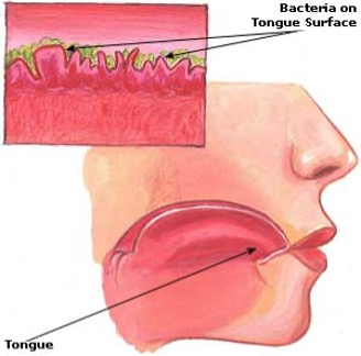 TREATING THE EMBARASSING PROBLEM OF BAD BREATH