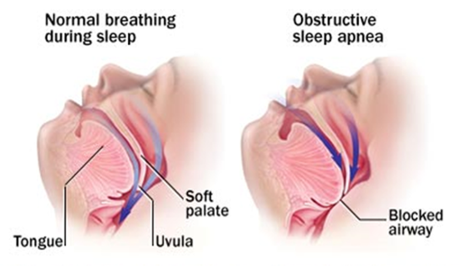 Obstructive Sleep Apnea Affects Thousands Of Bahamians