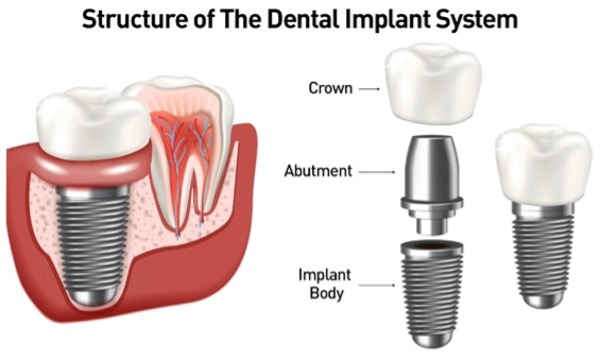 Most Important Benefits Of Dental Implants