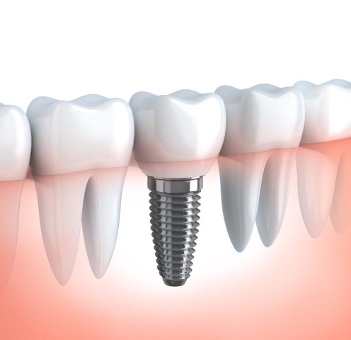 Dental Implants: What You Need To Know