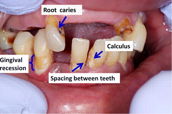 The Dental Implications Of Diabetes Prevalence     