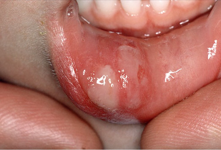 Mouth Ulcers Are Common Lesions