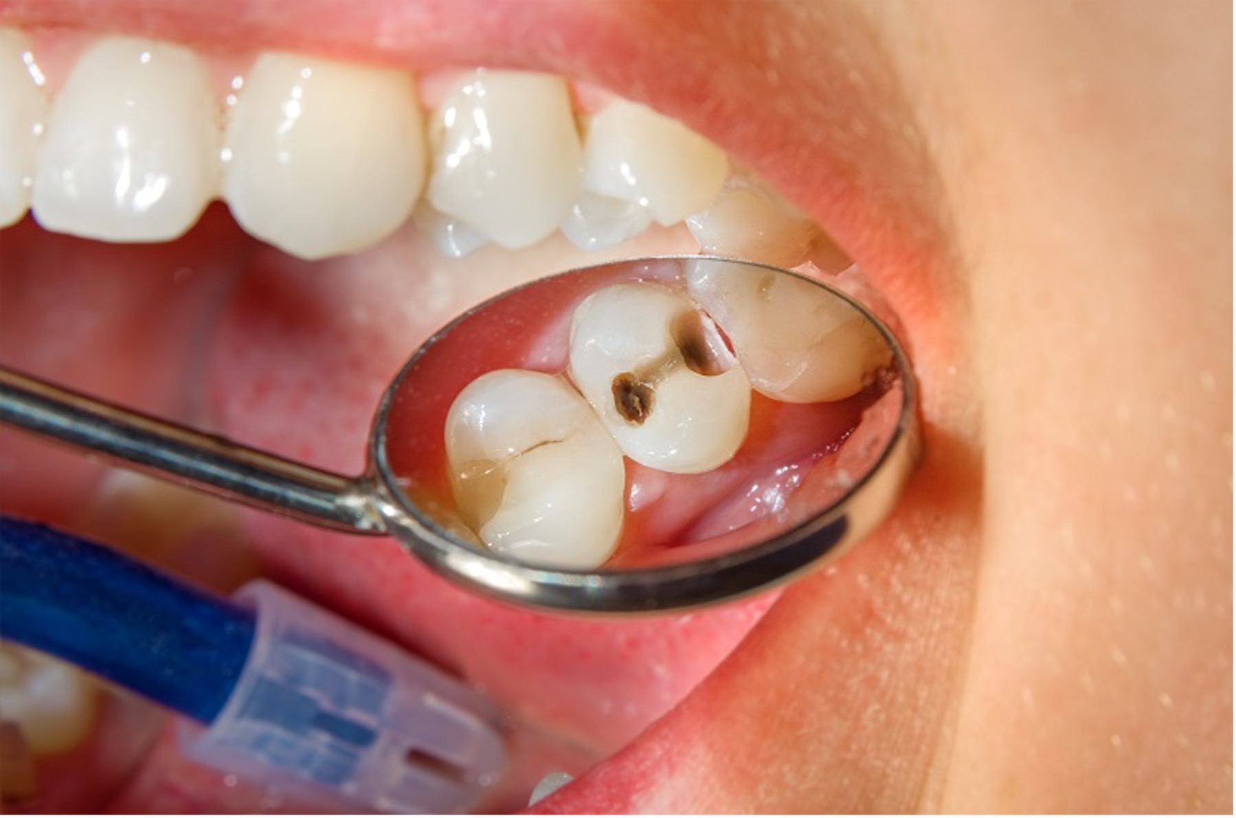 Rampant Dental Diseases Since COVID-19