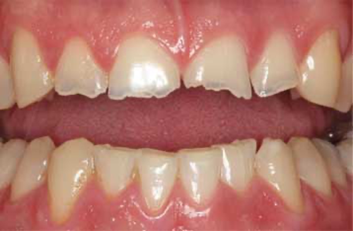 Teeth Grinding Causes Serious Oral Health Complications