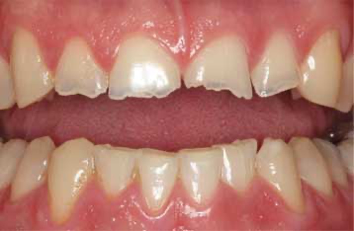 Teeth Grinding Causes Serious Oral Health Complications