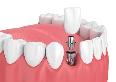 Are You A Candidate For Dental Implants?