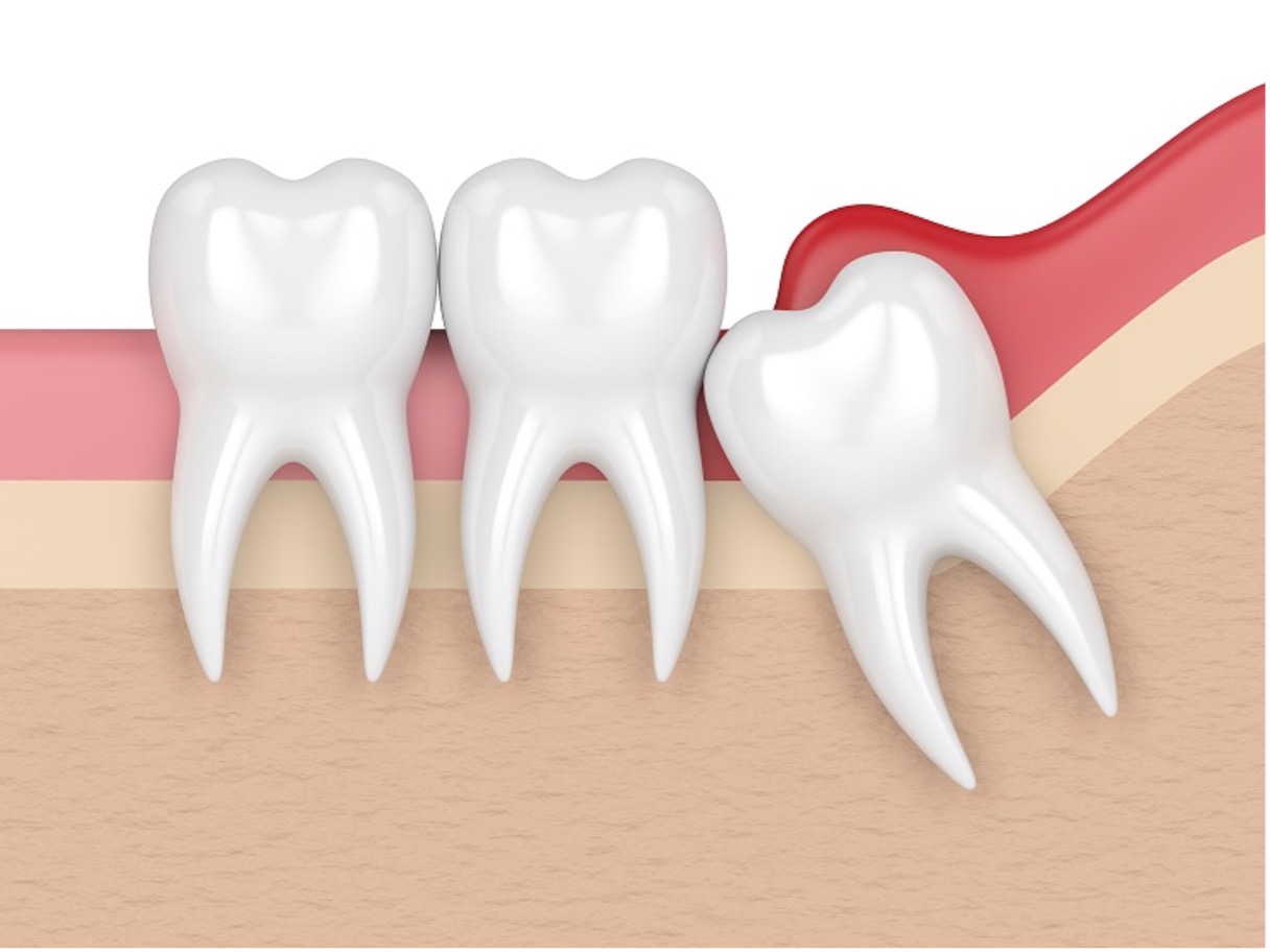 Most Common Dental Problems & Diseases part 2