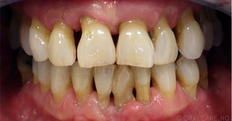 The Three Most Common & Serious Oral Diseases