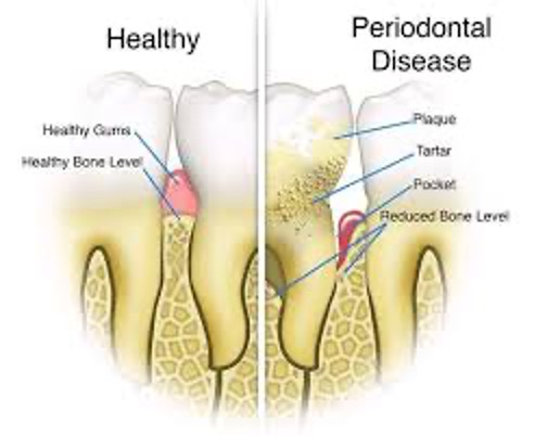 How a Periodontist Manages Gum Diseases?