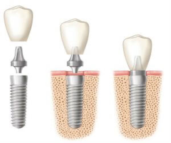 Smile Renewal: Unveiling the Benefits of Dental Implants