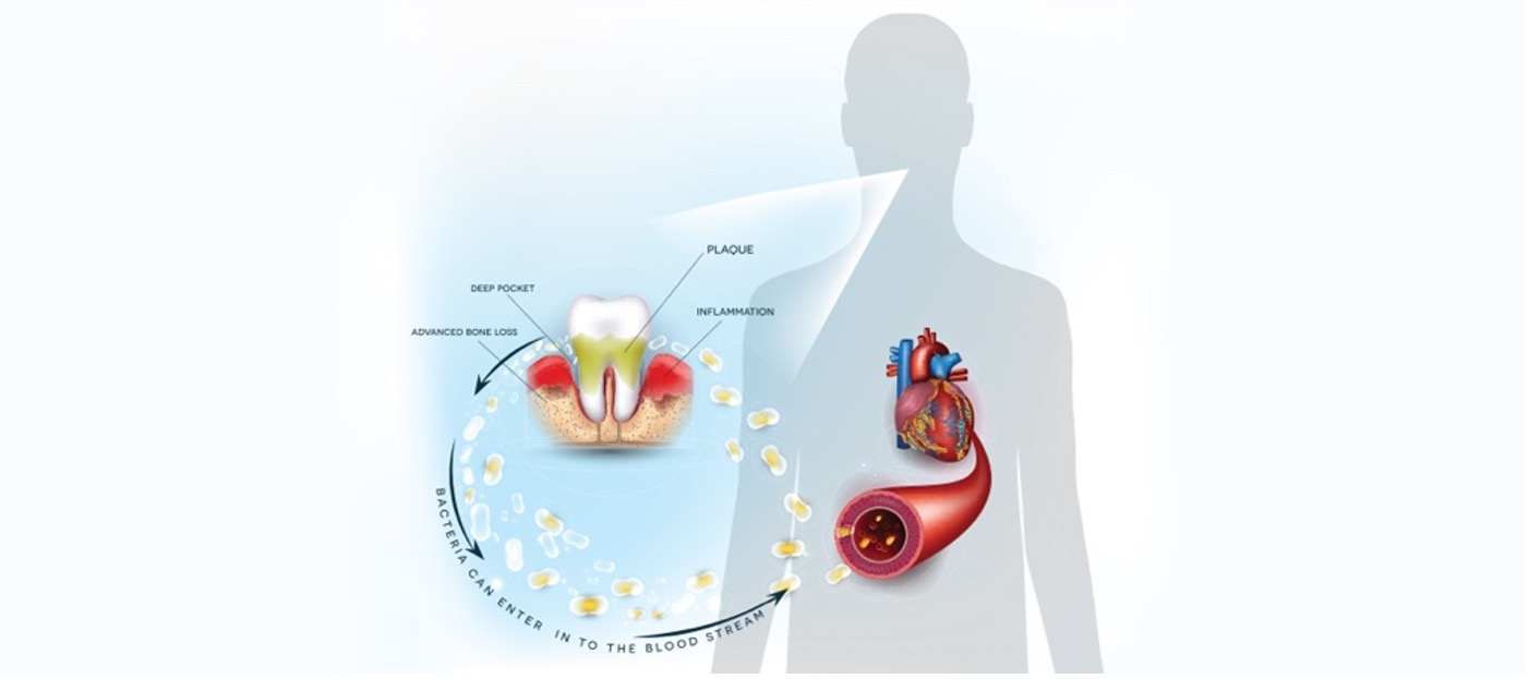 Gum Disease: The Silent Threat to Overall Wellness