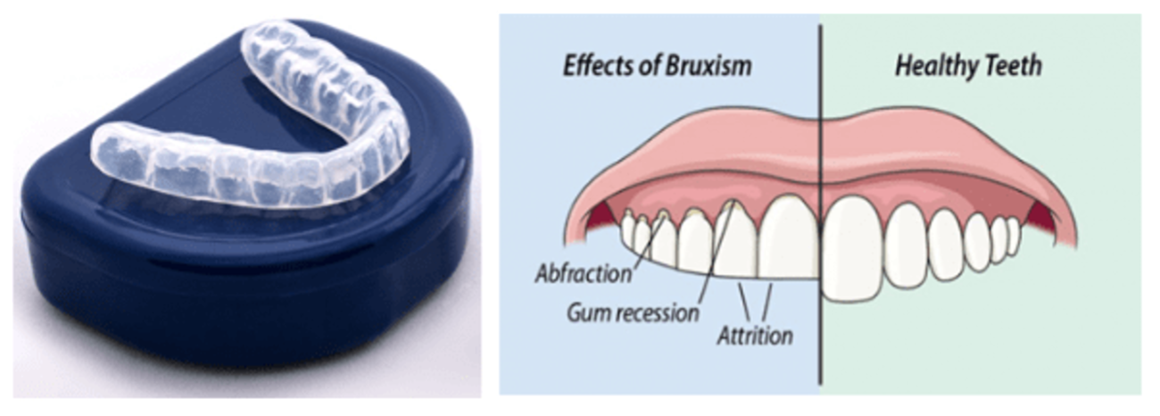The Hidden Link: Stress and Its Impact on Oral Health