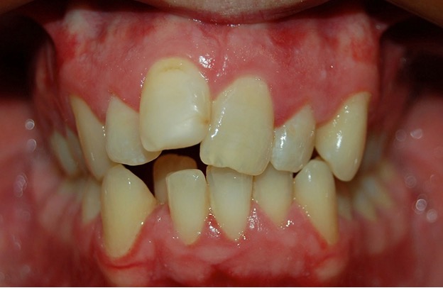 Orthodontic Advances: Fast Braces and Modern Options for Adults