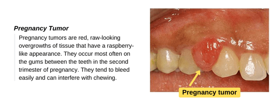 Understanding the Connection Between Periodontal Disease and Low Birth Weight Babies
