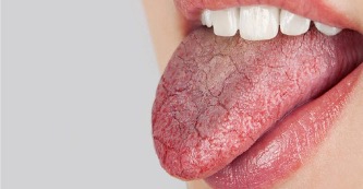Dry Mouth & “Ozempic Mouth”: A Rising Concern for Oral Health